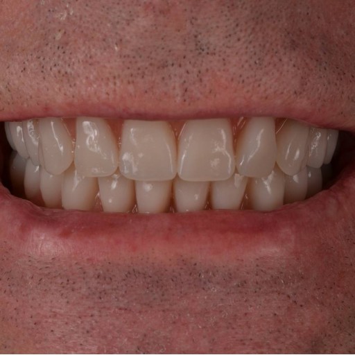 Total reconstruction with implants