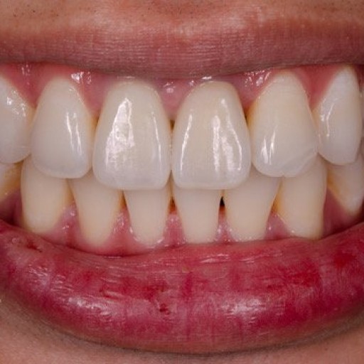Symmetrical and white ones