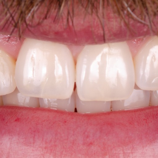 Placement of a dental implant