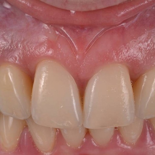 Replacement of unbased second incisors