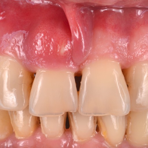 Replacement of a missing front tooth