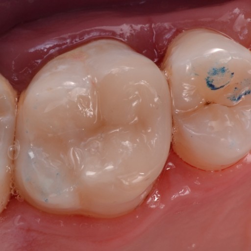 Replacement of an old amalgam filling with a new one