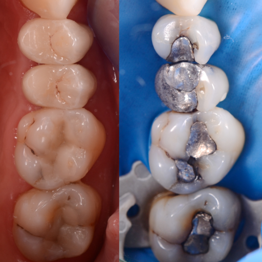 Replacement of amalgam fillings with ceramic crowns