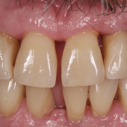 Treatment of periodontal disease, dental implants