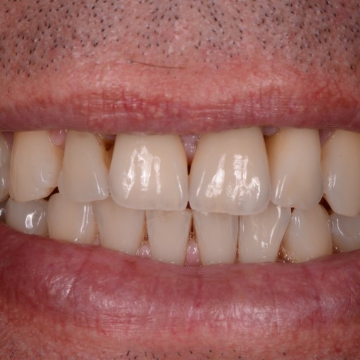 Replacing front crowns
