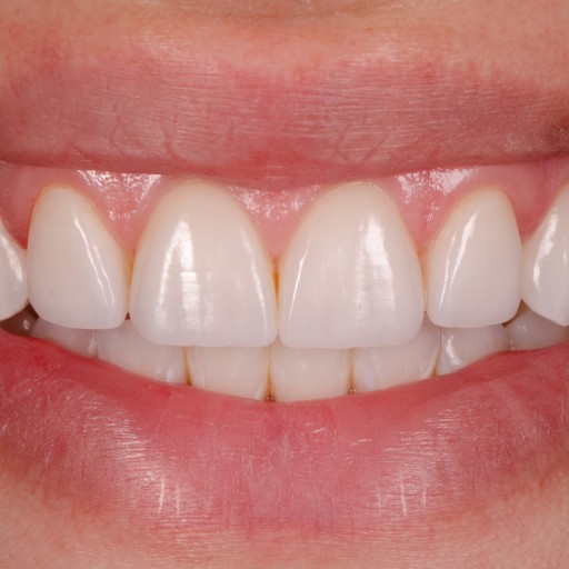 Agenesis of the second incisors